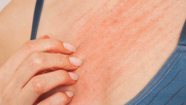 علت خارش سینه قبل از پریود