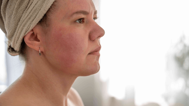 علت داغ شدن صورت در شب