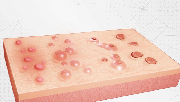 تبخال تناسلی چند روز طول می کشد؟