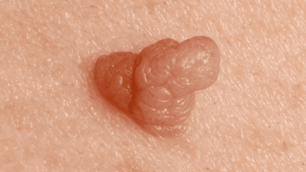 شکل زگیل تناسلی