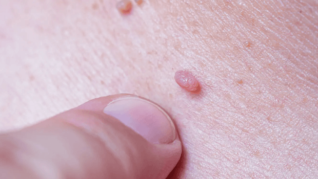 آیا هر برجستگی زگیل است؟