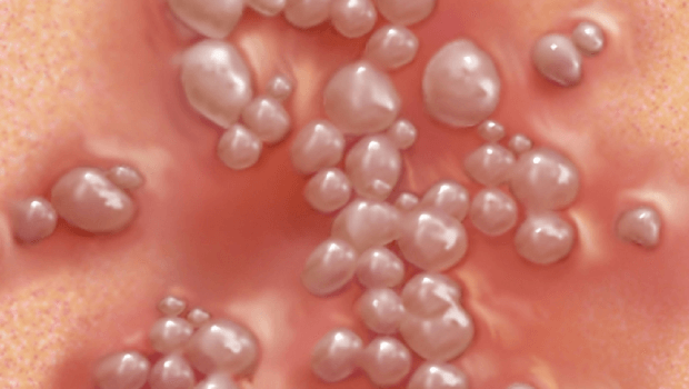 درمان سریع تبخال تناسلی