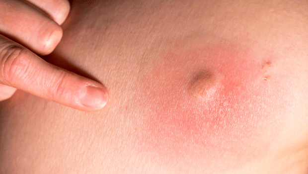 جوش و تبخال تناسلی چه تفاوتی دارند