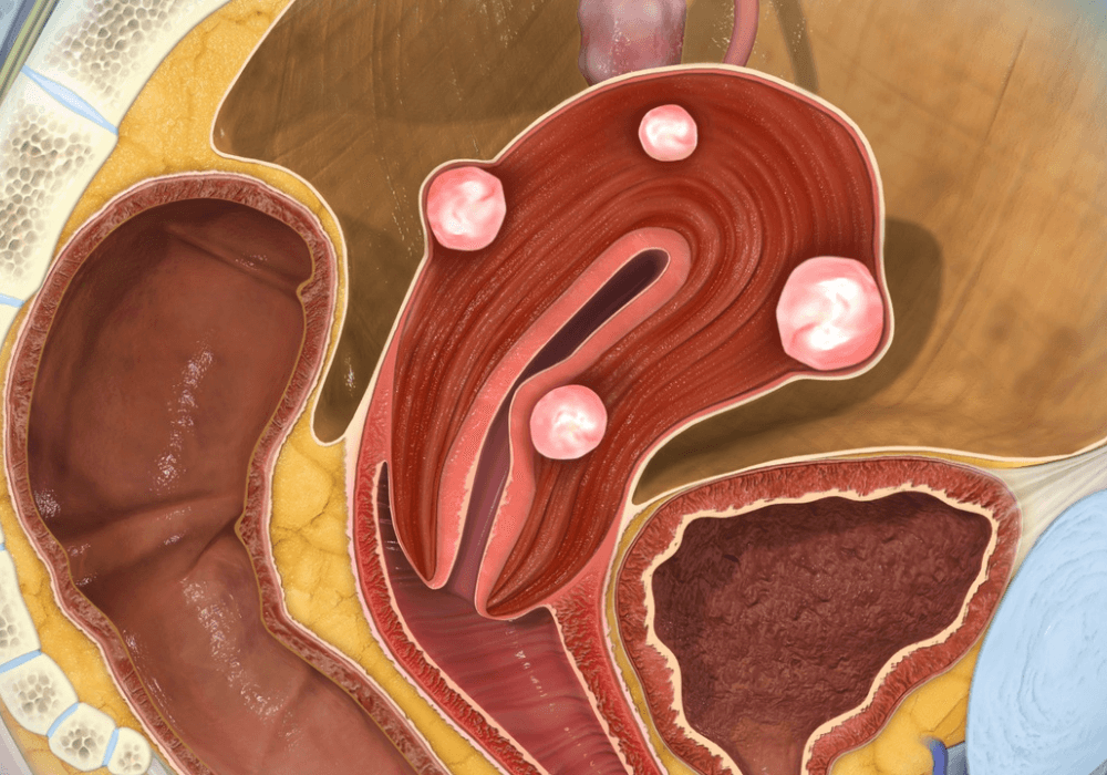 فیبروم رحم