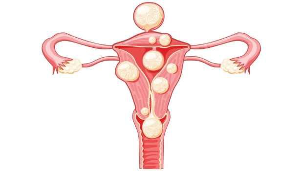 فیبروم یا میوم رحم چیست؟