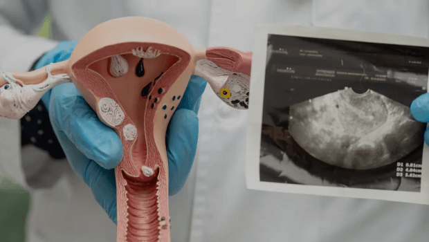 چه زمانی فیبروم مانع بارداری میشود؟