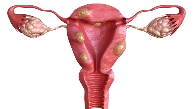 درمان فیبروم قبل و حین بارداری