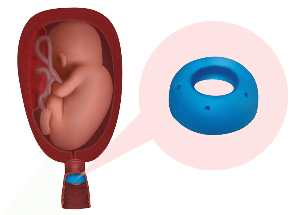 پساری چند درصد جلوی زایمان زودرس را می گیرد