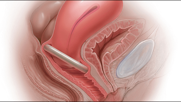 جلوگیری از زایمان زودرس با پساری