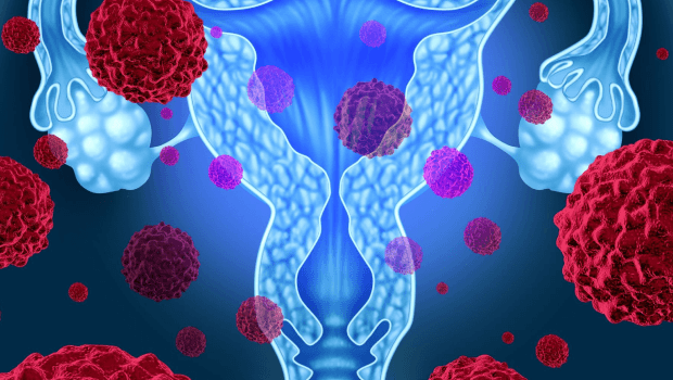 چه زمانی جراحی برای فیبروم رحم لازم میشود؟