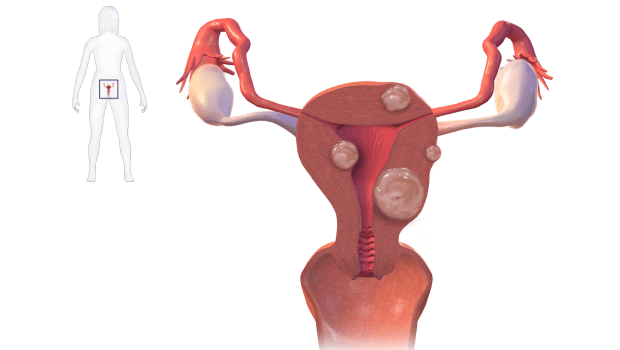 انواع جراحی برای فیبروم رحم