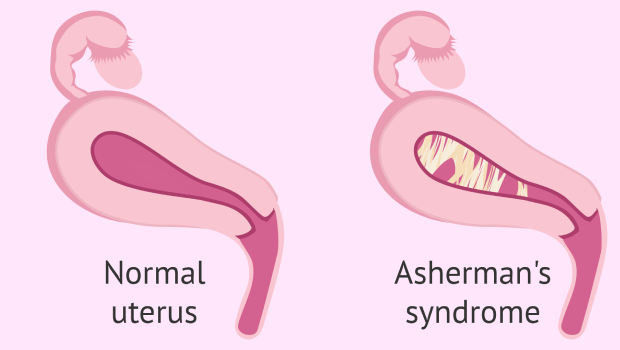 چسبندگی رحم چیست