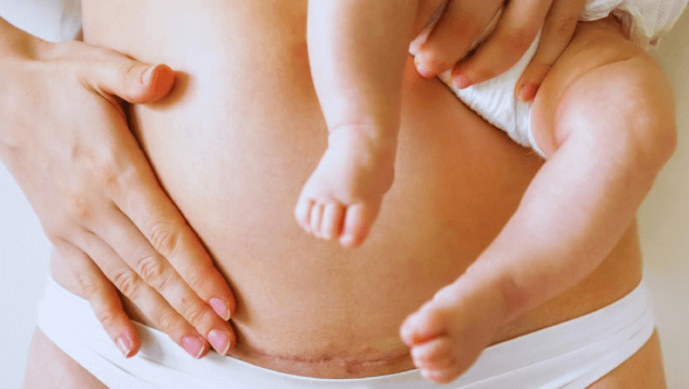 زایمان طبیعی یا سزارین