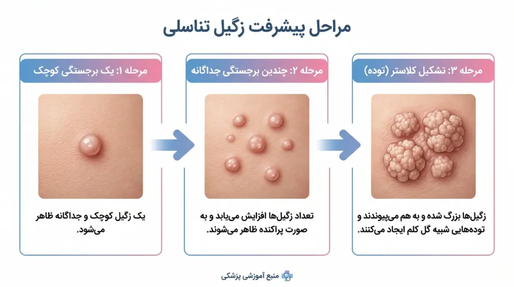 مراحل پیشرفت زگیل تناسلی اولیه تا خوشه‌ای اینفوگرافیک